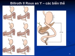 2 Roux Điều trị ung thư dạ dày - 2019 - Đại học Y dược TPHCM | PPT