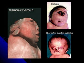 Ciclopía.
Dismorfias faciales múltiples
 