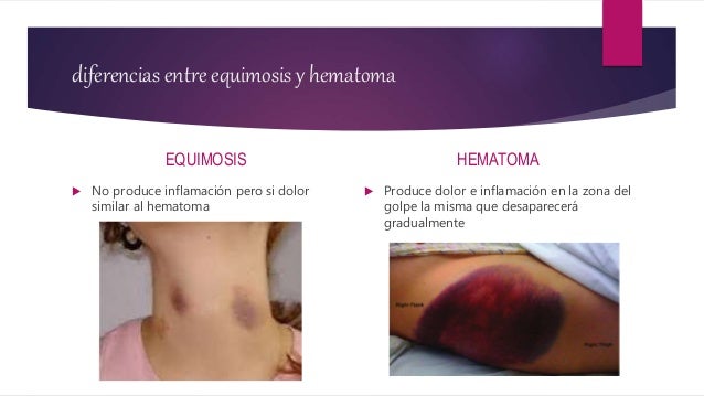 Equimosis O Hematoma SOLUTION: Trastornos Hemorragicos Y Trombosis