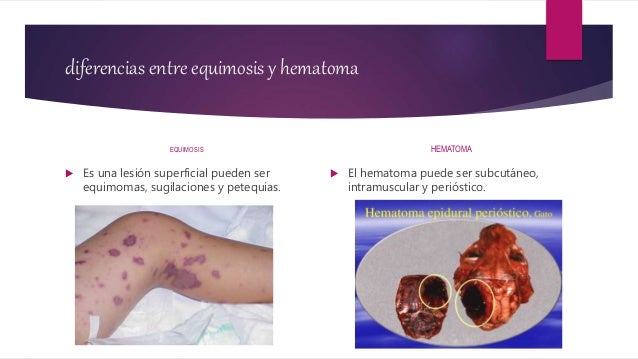 Qual a diferença entre equimose e hematoma?