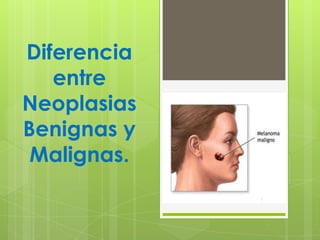 Diferencia
   entre
Neoplasias
Benignas y
 Malignas.
 