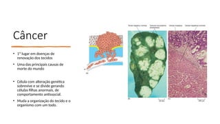 Câncer
• 1º lugar em doenças de
renovação dos tecidos
• Uma das principais causas de
morte do mundo
• Célula com alteração genética
sobrevive e se divide gerando
células filhas anormais, de
comportamento antissocial.
• Muda a organização do tecido e o
organismo com um todo.
 