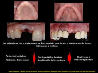 Las indicaciones en la implantología se han ampliado para incluir la restauración de dientes
individuales o múltiples
Pará...