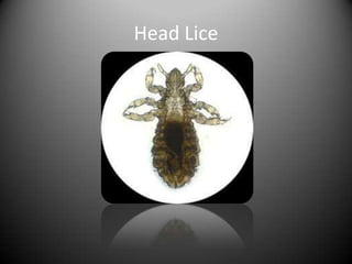 Head Lice
 
