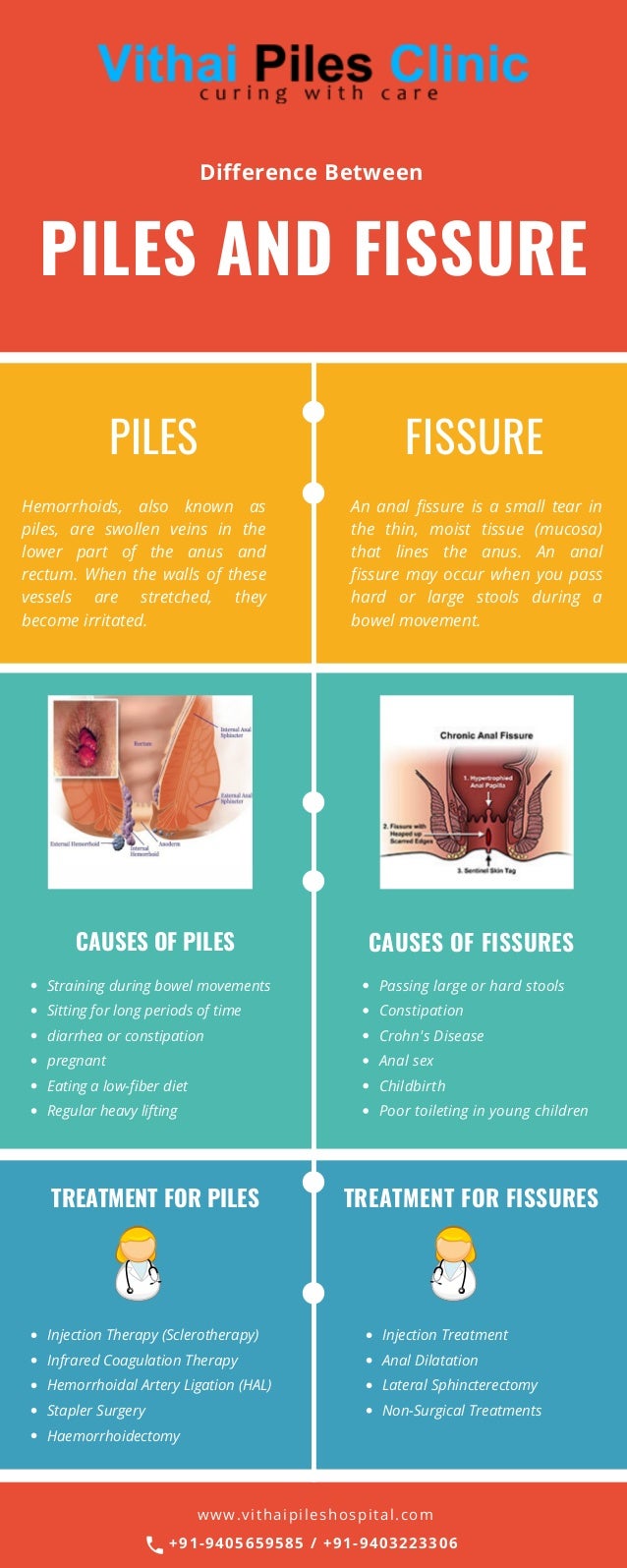 wallpapers Piles And Fissures Real Photos difference between anal fissures and