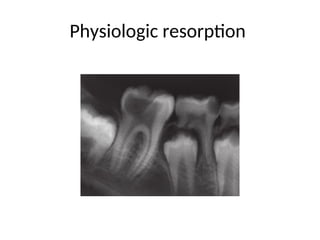 Physiologic resorption
 