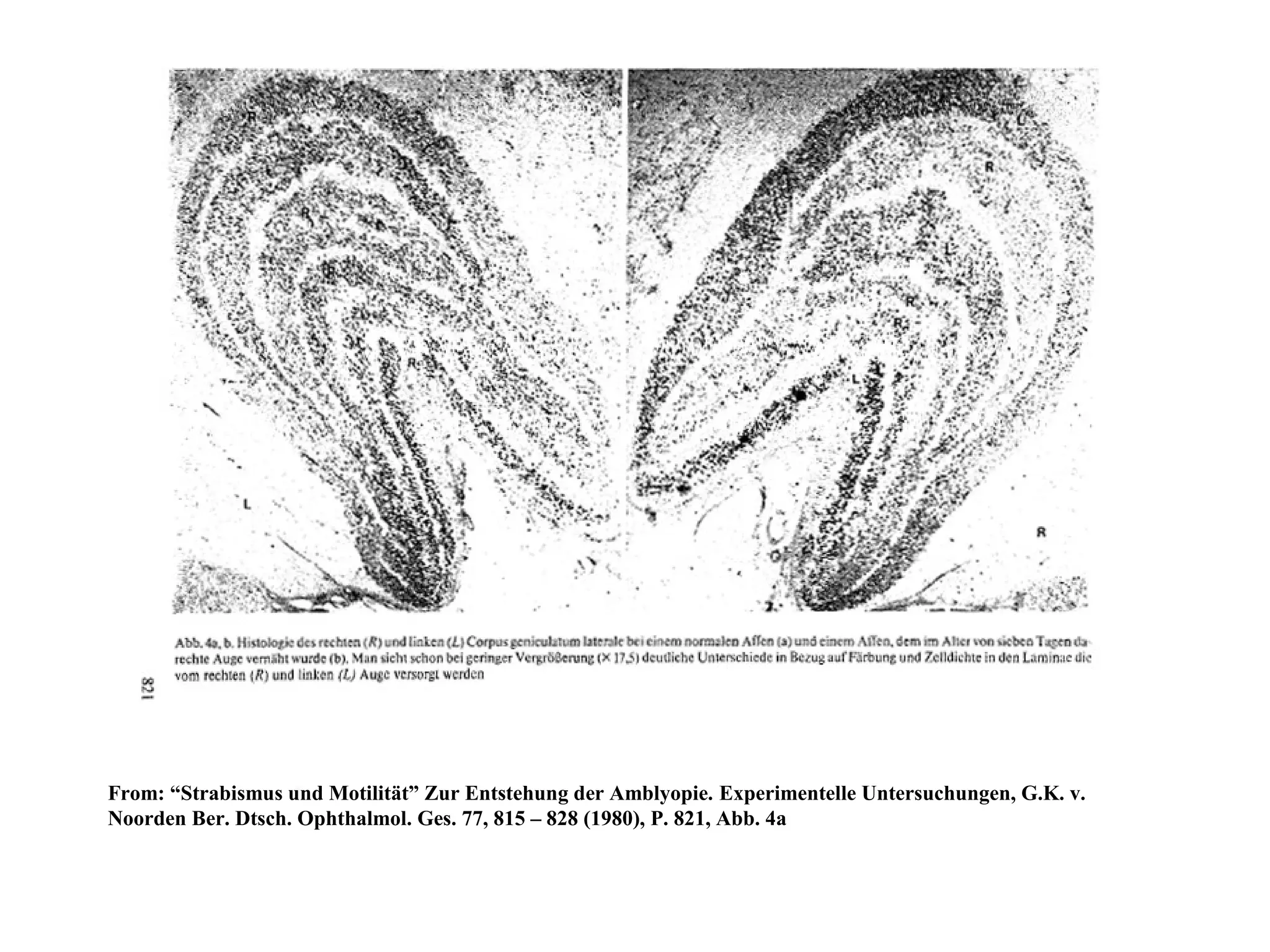 From: “Strabismus und Motilität” Zur Entstehung der Amblyopie. Experimentelle Untersuchungen, G.K. v.
Noorden Ber. Dtsch. Ophthalmol. Ges. 77, 815 – 828 (1980), P. 821, Abb. 4a
 