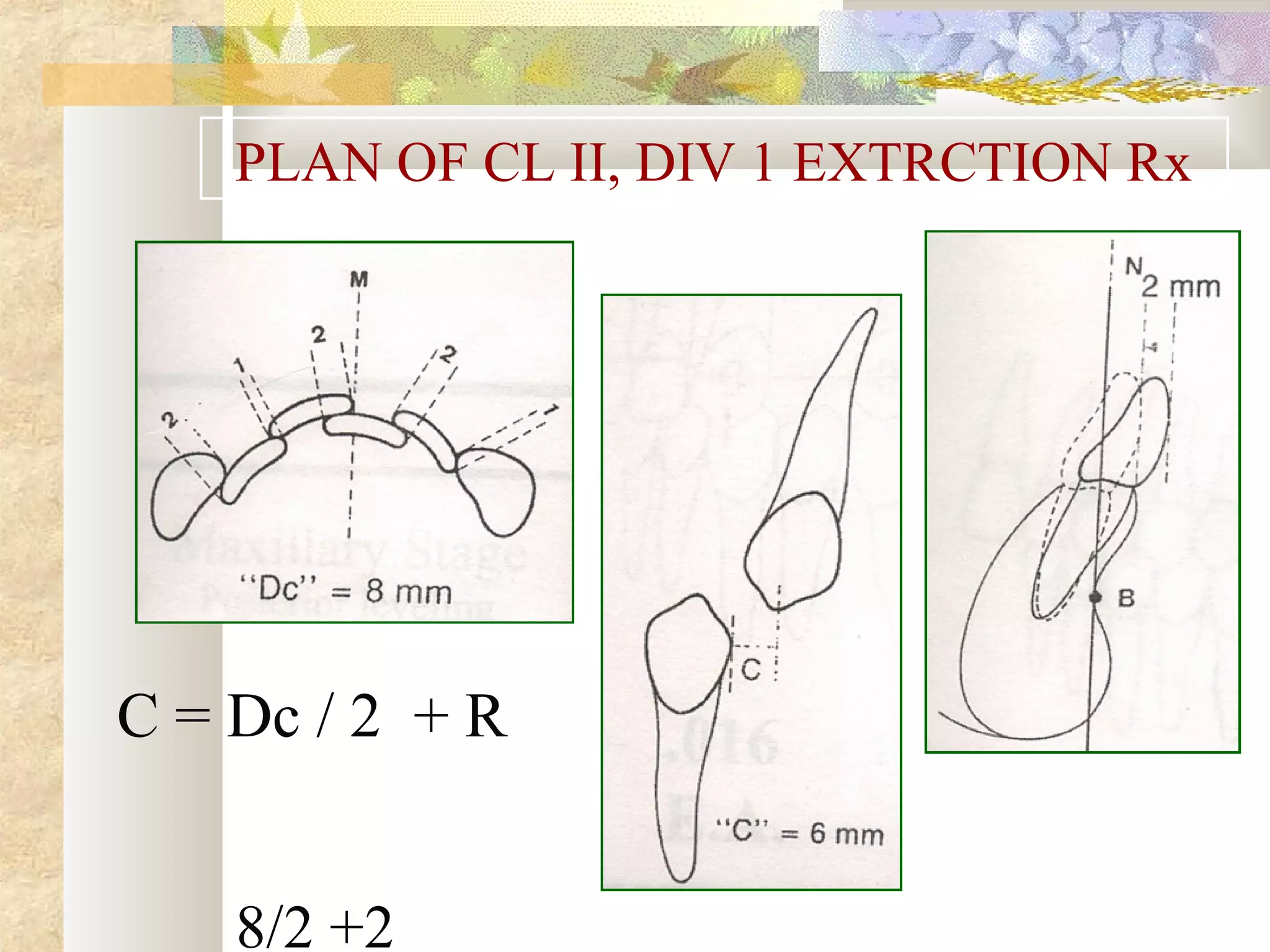 PLAN OF CL II, DIV 1 EXTRCTION Rx
C = Dc / 2 + R
8/2 +2
 