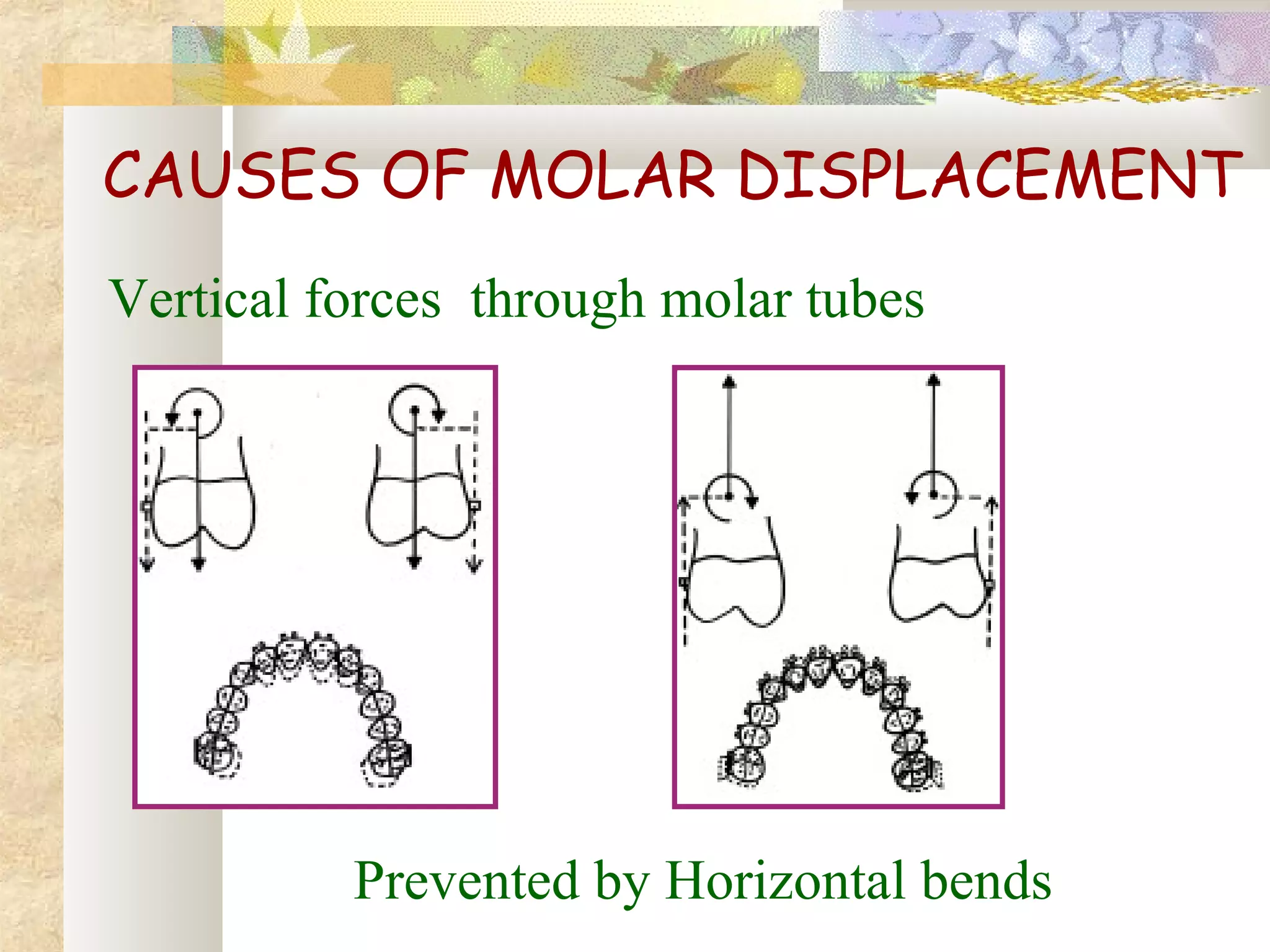 CAUSES OF MOLAR DISPLACEMENT
Vertical forces through molar tubes
Prevented by Horizontal bends
 