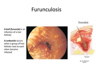 Furunculosis
A boil (furuncle) is an
infection of a hair
follicle]
A carbuncle occurs
when a group of hair
follicles next to each
other become
infected
 