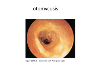 otomycosis
 