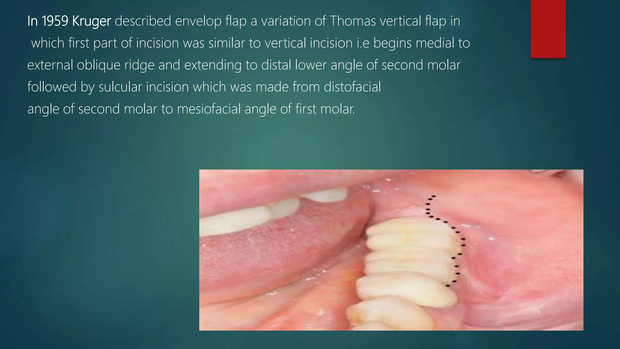 Different flap designs used for the management of impacted wisdom | PPTX