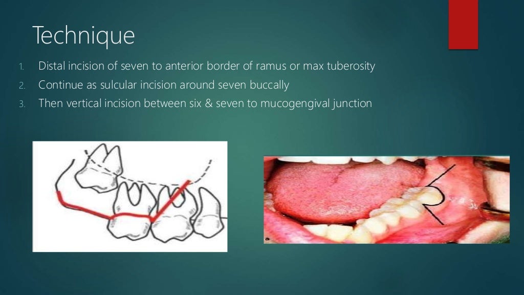 Different flap designs used for the management of impacted wisdom