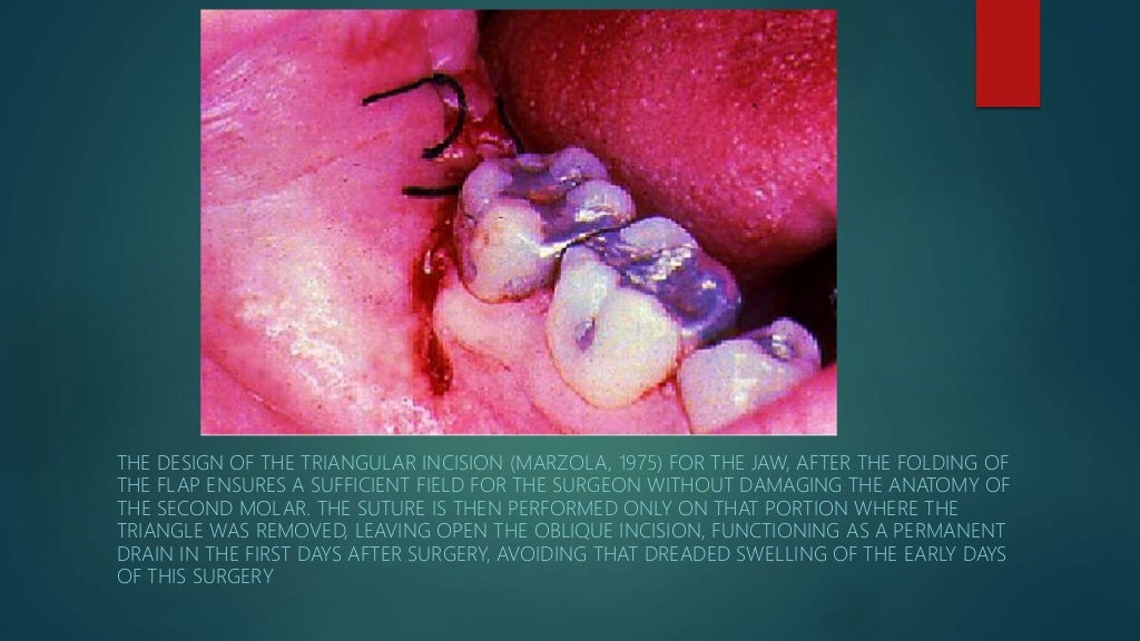 Different flap designs used for the management of impacted wisdom