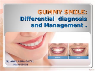 GUMMY SMILE:GUMMY SMILE:
Differential diagnosisDifferential diagnosis
and Management .and Management .
Dr. ABHILASHA GOYAL
PG STUDENT
 