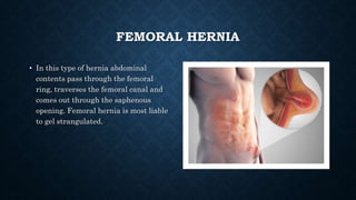 Differential Diagnosis Of Femoral Hernia Bhadra pptx Differential Diagnosis Of Femoral Hernia Bhadra pptx