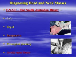 Diagnosing Head and Neck Masses
 F.N.A.C – Fine Needle Aspiration Biopsy is
 Safe
 Rapid
 Inexpensive
 Presurgical planning
 Avoids open biopsy
 