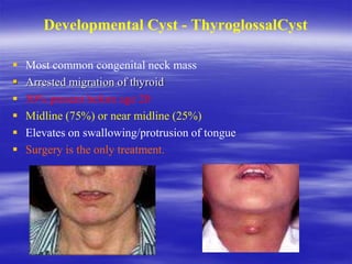 Developmental Cyst - ThyroglossalCyst
 Most common congenital neck mass
 Arrested migration of thyroid
 50% present before age 20
 Midline (75%) or near midline (25%)
 Elevates on swallowing/protrusion of tongue
 Surgery is the only treatment.
 