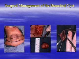 Surgical Management of the Branchial Cyst
 