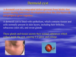 Dermoid cyst
A dermoid cyst is a congenital defect (present from birth) that
occurs during embryonic development when the skin layers do
not properly grow together.
A dermoid cyst is lined with epithelium, which contains tissues and
cells normally present in skin layers, including hair follicles,
sebaceous (skin oil), and sweat glands.
These glands and tissues secrete their normal substances which
collect inside the cyst, causing it to grow and enlarge.
 