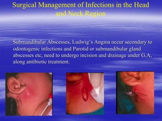 Surgical Management of Infections in the Head
and Neck Region
Submandibular Abscesses, Ludwig’s Angina occur secondary to
odontogenic infections and Parotid or submandibular gland
abscesses etc, need to undergo incision and drainage under G.A,
along antibiotic treatment.
 