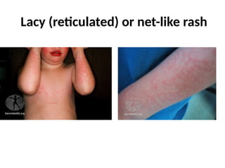 Differential Diagnosis of Infectious Exanthems | PPTX
