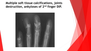 Differential diagnosis of musculoskeletal involvement in rheumatoid ...