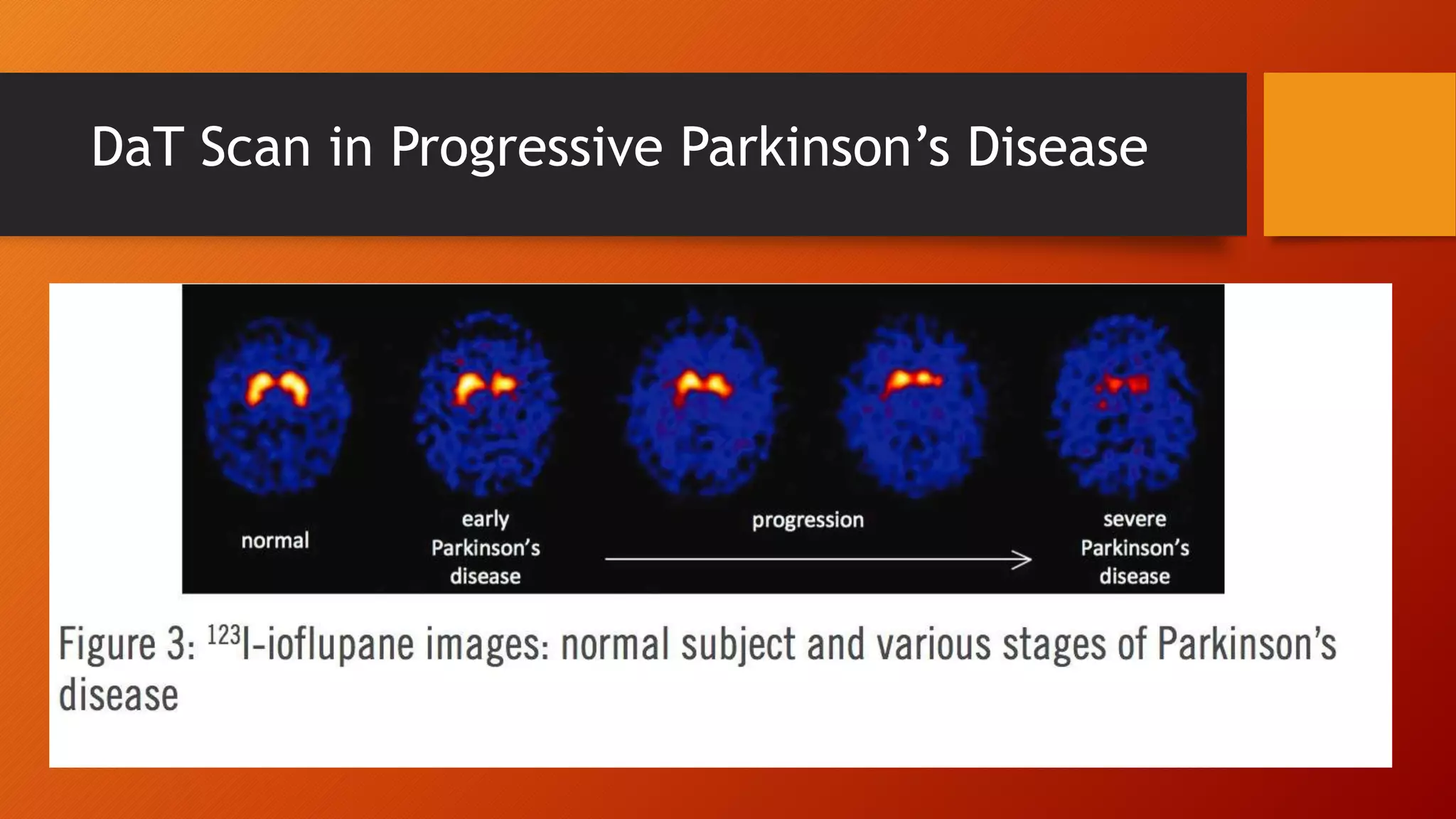 Differential diagnosis of parkinson's disease | PPTX