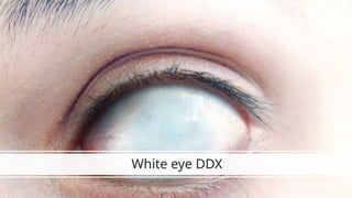 DIFFERENTIAL DIAGNOSIS OF RED AND WHITE EYE.pptx