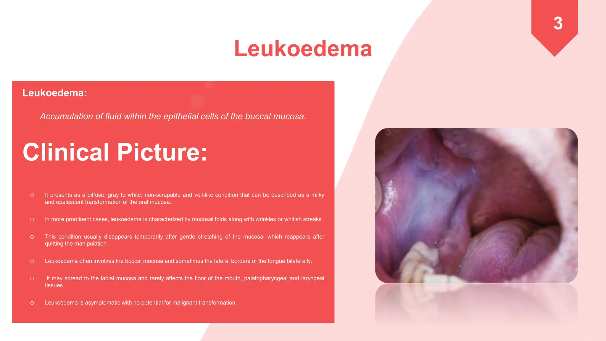 Differential Diagnosis of White Lesions in the oral cavity.pdf