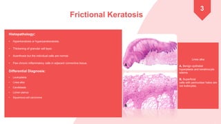 Differential Diagnosis of White Lesions in the oral cavity.pdf