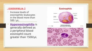 3
-
eosinophilia
:
- Increase levels of
eosinophilic leukocytes
in the blood more than
500 / μL.
- Hypereosinophilia is
generally defined as
a peripheral blood
eosinophil count
greater than 1500/μL
 