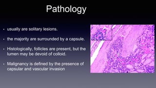 Pathology
• usually are solitary lesions.
• the majority are surrounded by a capsule.
• Histologically, follicles are present, but the
lumen may be devoid of colloid.
• Malignancy is defined by the presence of
capsular and vascular invasion
 