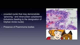 • crowded nuclei that may demonstrate
“grooving,” and intranuclear cytoplasmic
inclusions (leading to the designation of
Orphan Annie nuclei)
• Presence of Psammoma bodies
 