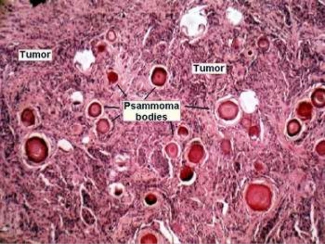 Differentiated thyroid carcinoma