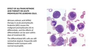 Atra Rash differentiation syndrome in Acute Promyelocytic Leukemia.pptx