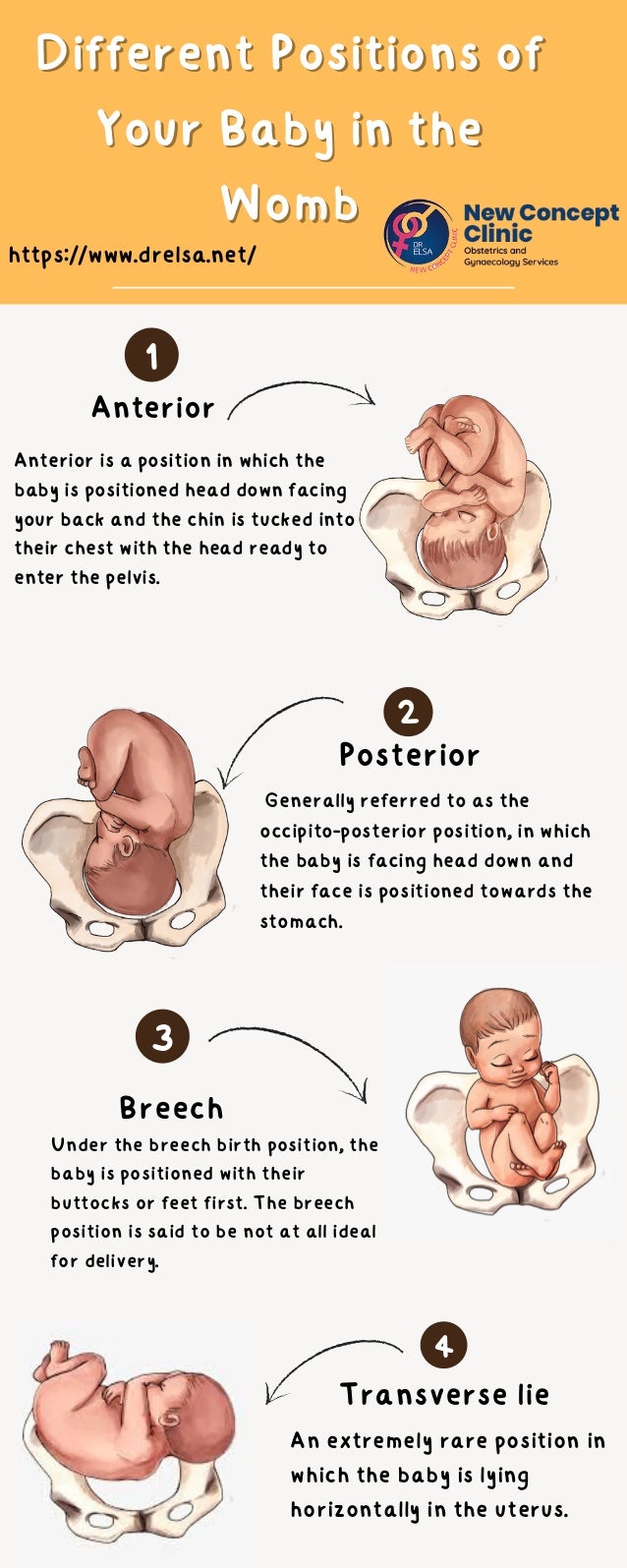Different Positions of
Different Positions of
Your Baby in the
Your Baby in the
Womb
Womb




Anterior
1
3
2
4
Posterior
Breech
Transverse lie
Anterior is a position in which the
baby is positioned head down facing
your back and the chin is tucked into
their chest with the head ready to
enter the pelvis.
Generally referred to as the
occipito-posterior position, in which
the baby is facing head down and
their face is positioned towards the
stomach.
Under the breech birth position, the
baby is positioned with their
buttocks or feet first. The breech
position is said to be not at all ideal
for delivery.
An extremely rare position in
which the baby is lying
horizontally in the uterus.
https://www.drelsa.net/
 