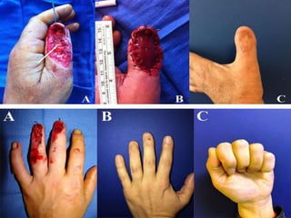 Different technique in skin grafting