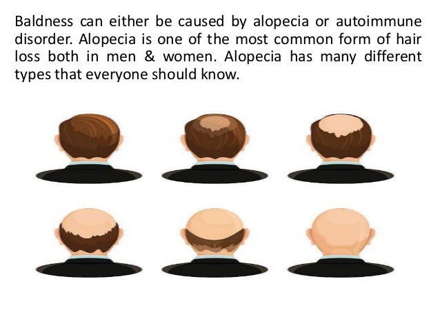 Different Types Of Alopecia