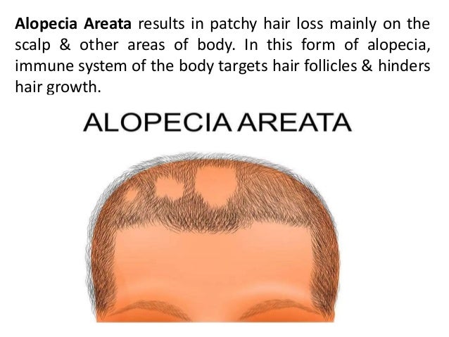 Different Types Of Alopecia