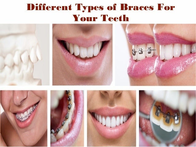 What are some different types of braces?