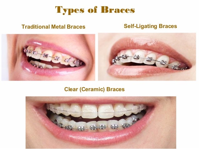 different types of braces