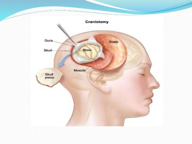 Different Types Of Brain Surgery