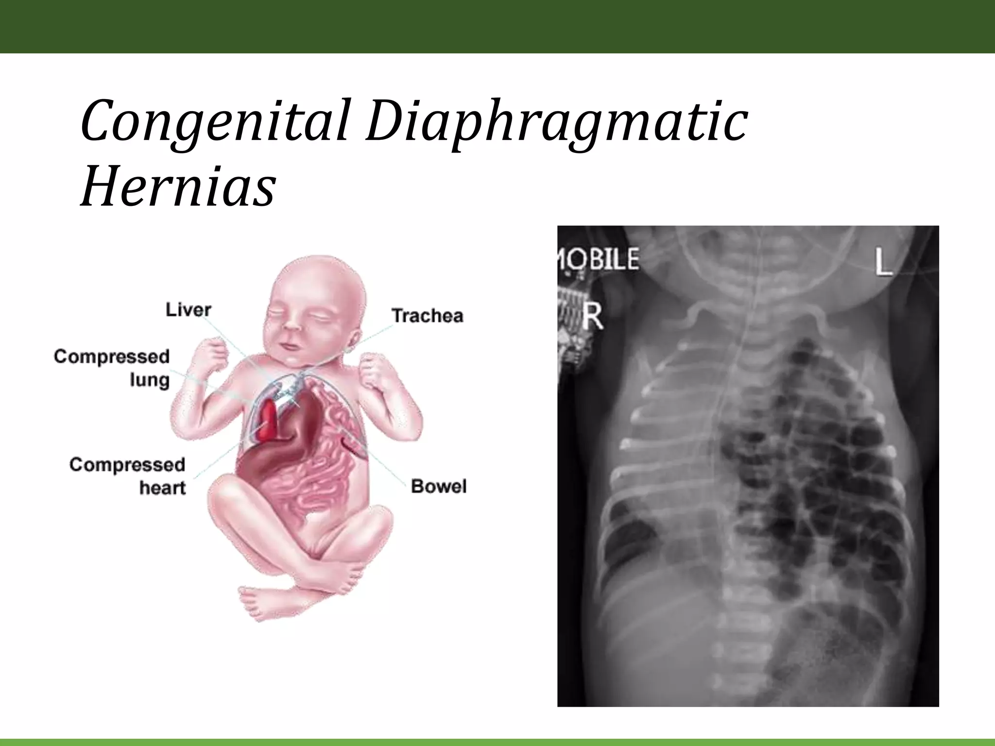 Congenital Diaphragmatic
Hernias
 
