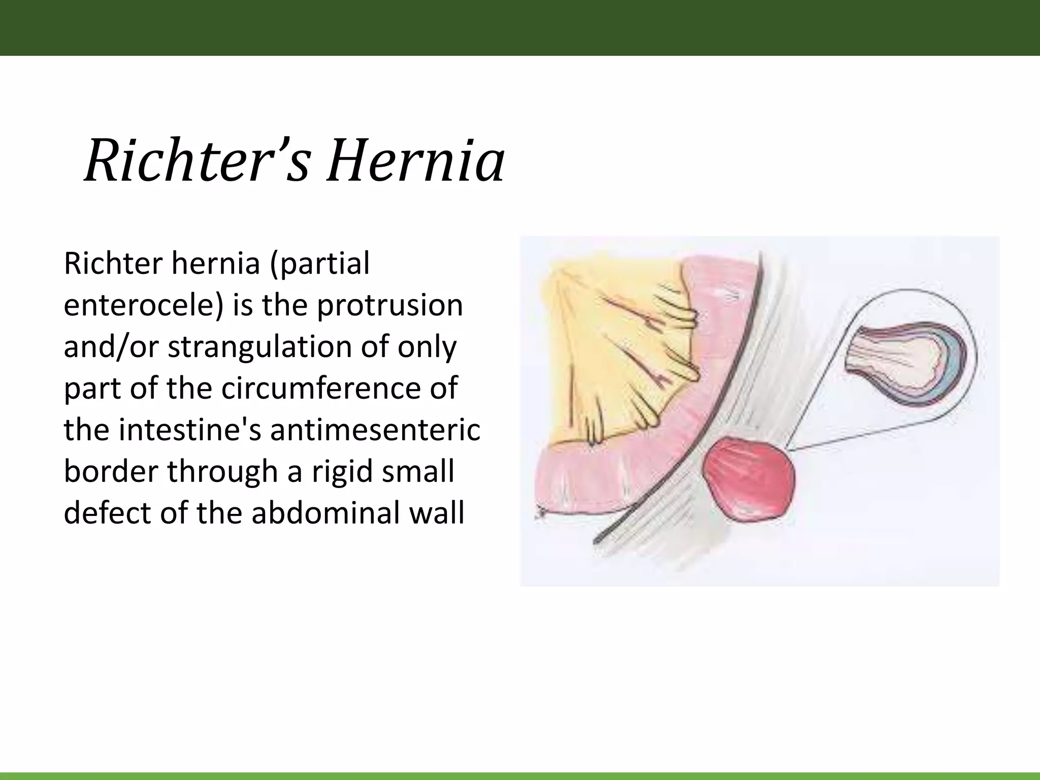 Richter’s Hernia
Richter hernia (partial
enterocele) is the protrusion
and/or strangulation of only
part of the circumference of
the intestine's antimesenteric
border through a rigid small
defect of the abdominal wall
 