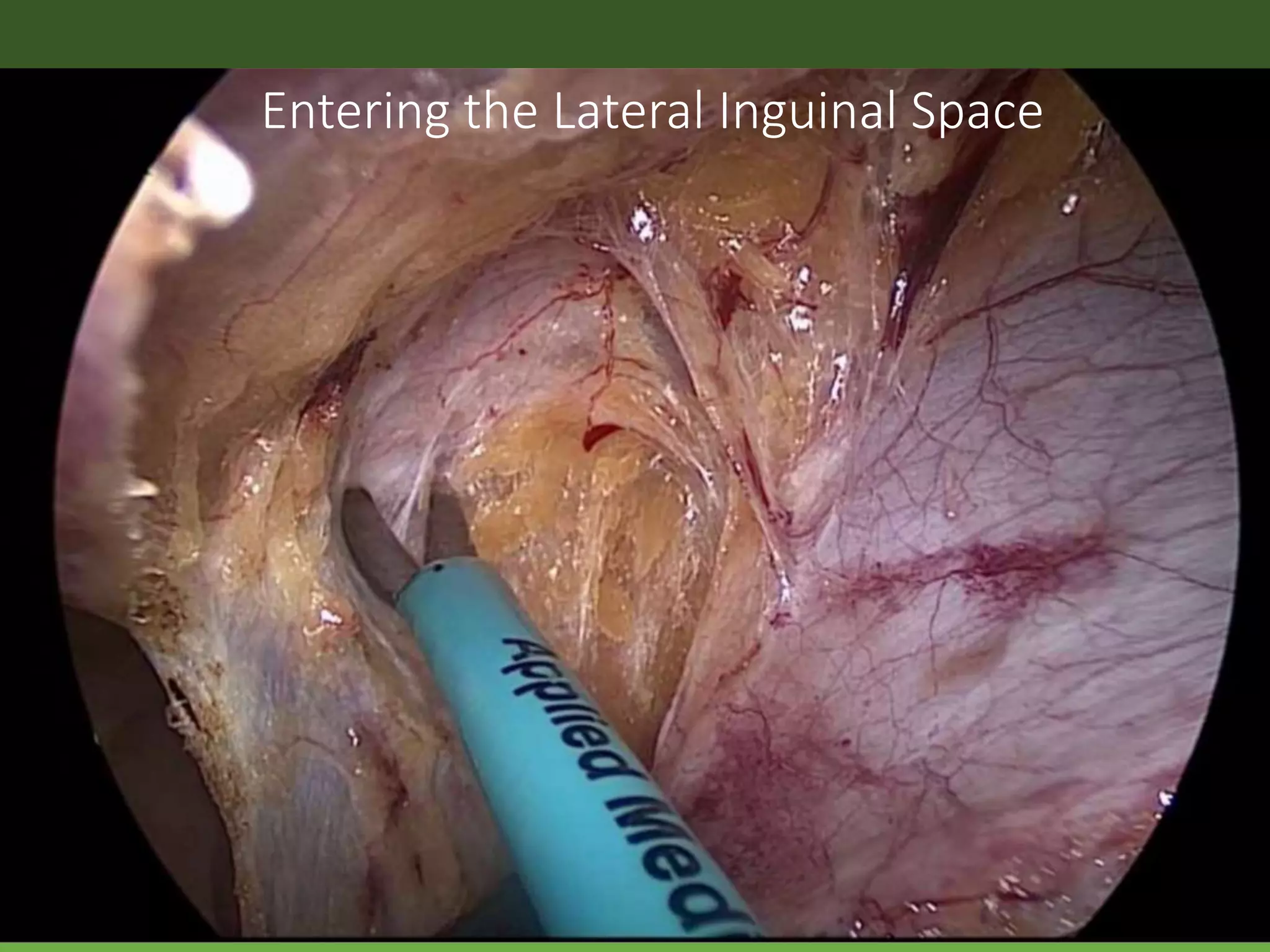 Entering the Lateral Inguinal Space
 