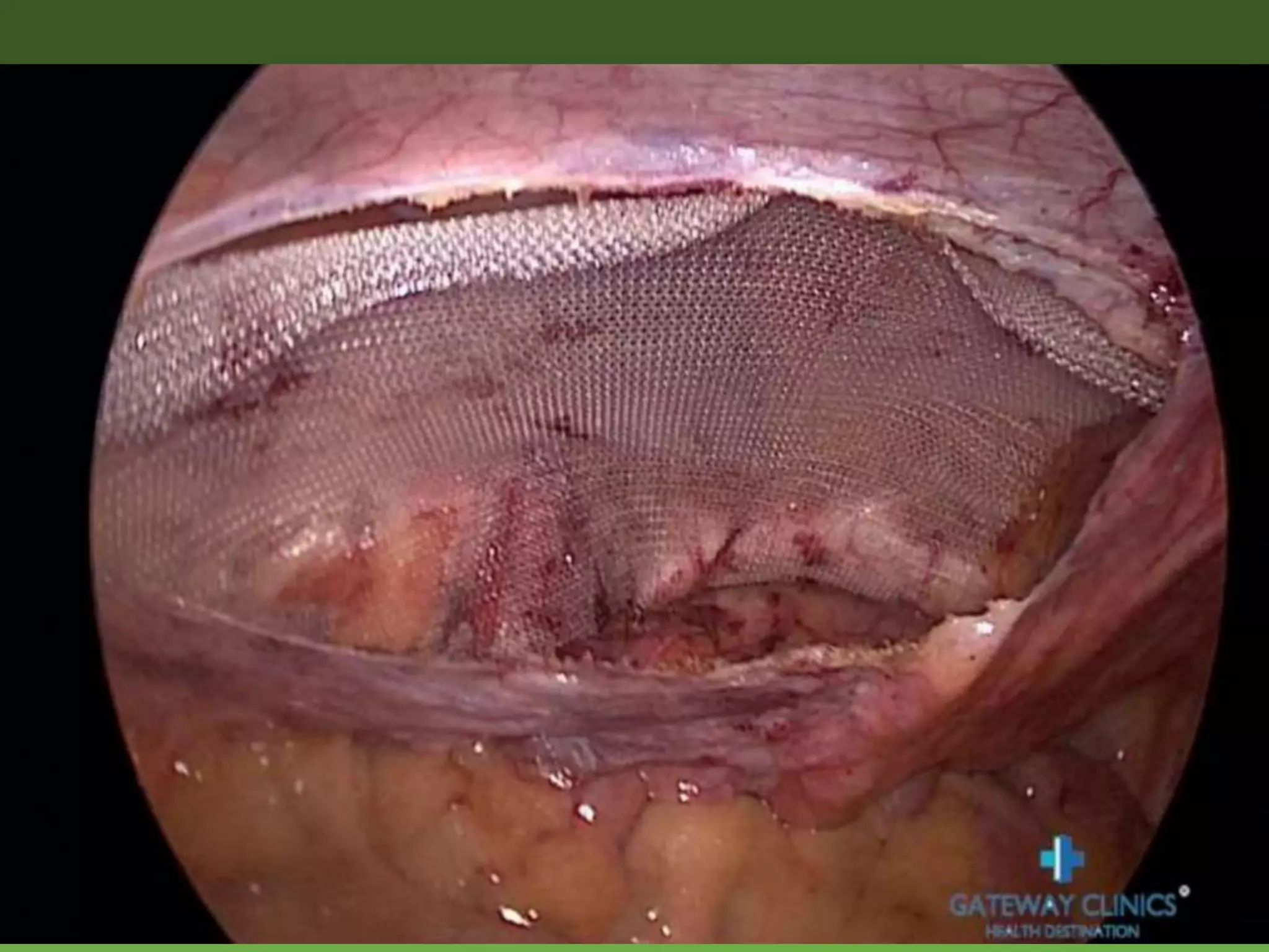 TAPP: STEP 5: Deploying and
Anchoring the Mesh
 