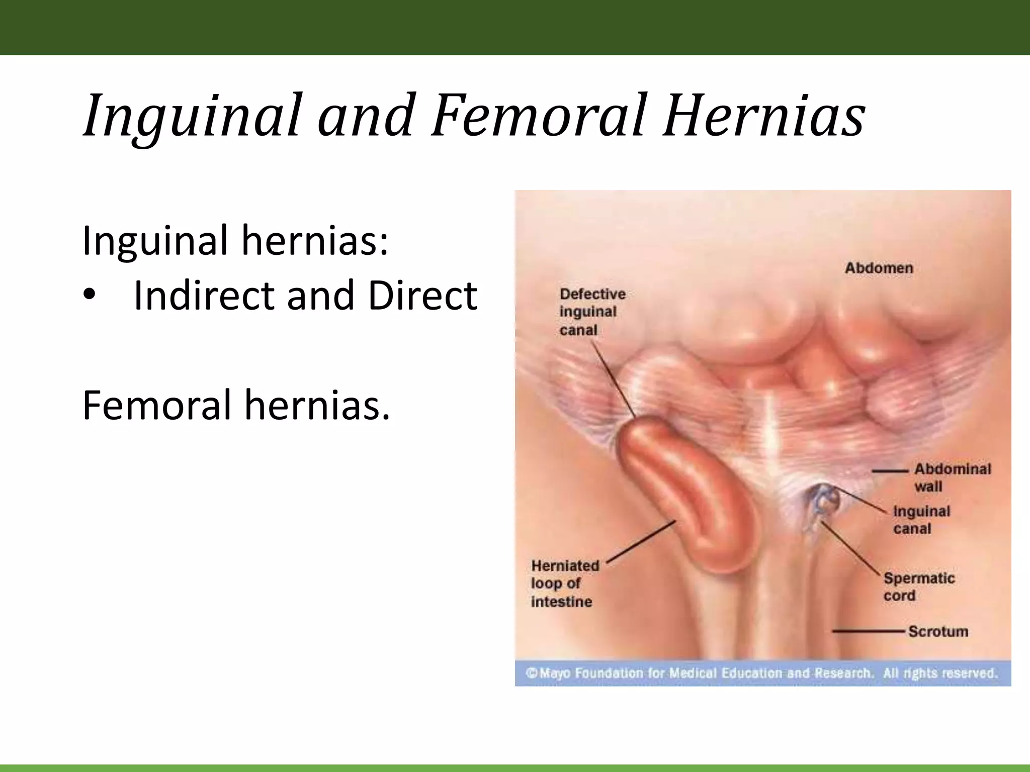 Inguinal and Femoral Hernias
Inguinal hernias:
• Indirect and Direct
Femoral hernias.
 