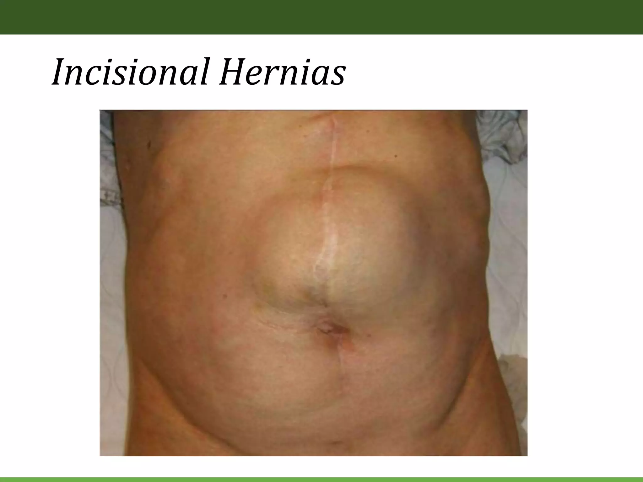 Incisional Hernias
 