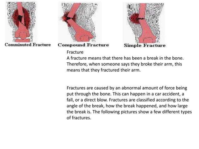 Different types of painful fractures | PPT